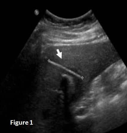 Toothpick stuck deals in throat